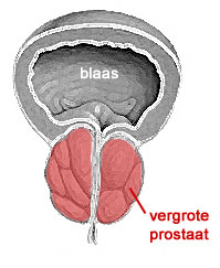 vergrote prostaat (prostaat hypertrofie)